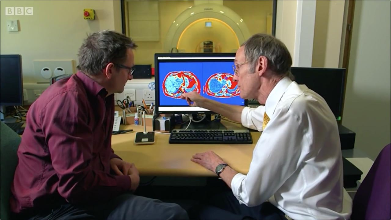 英国媒体:了解“脂肪肝-糖尿病”的逆转